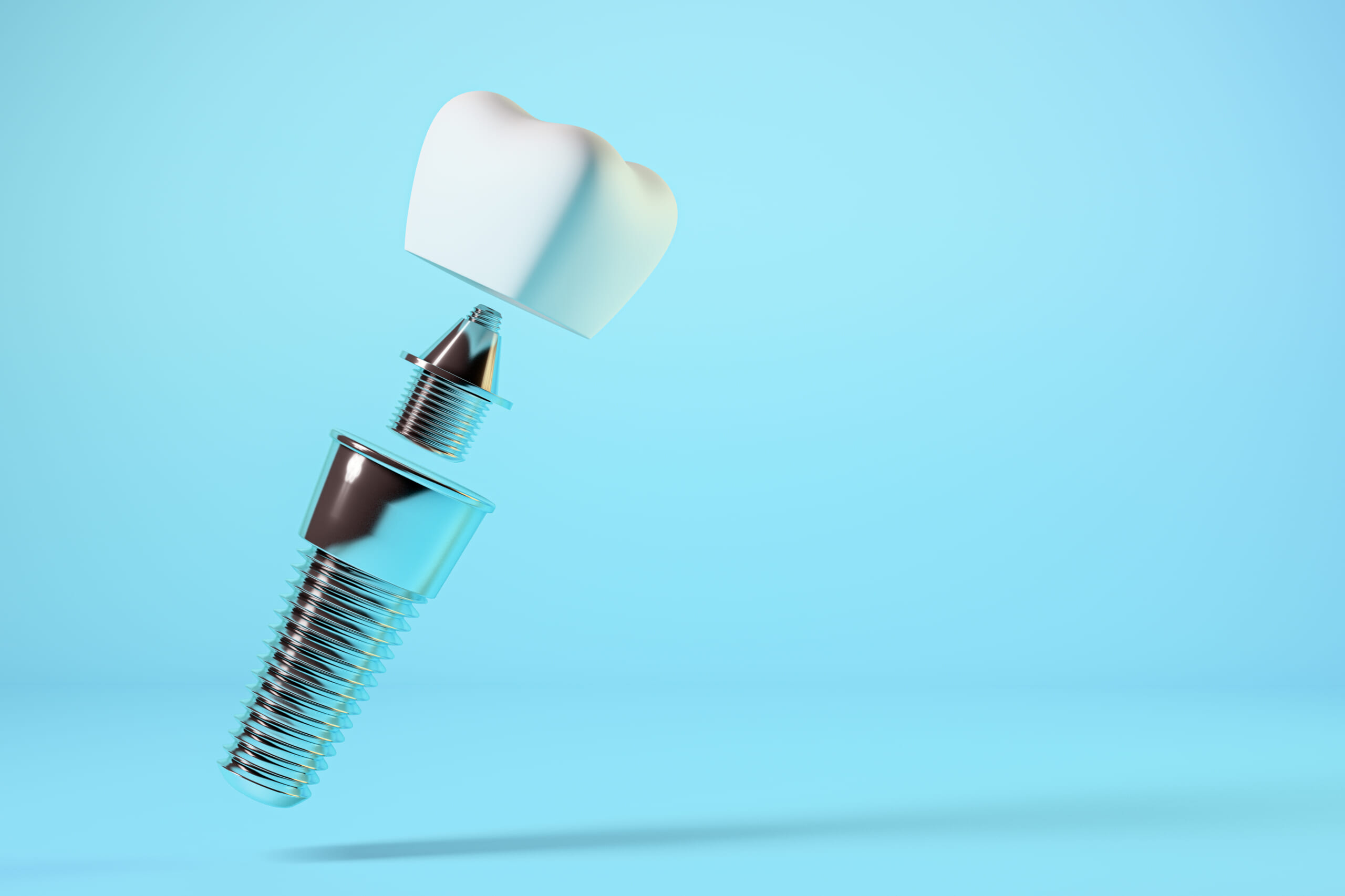 インプラントの基礎知識と正しい理解